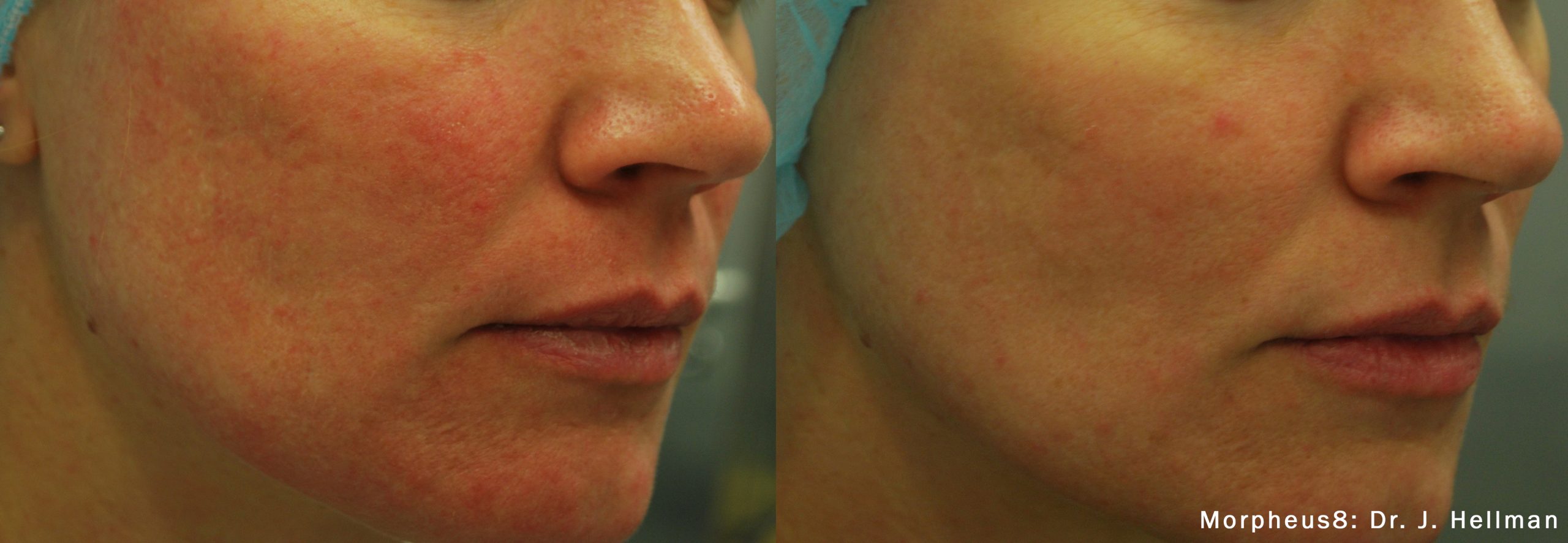 Morpheus8 Skin Treatment Before/Afters