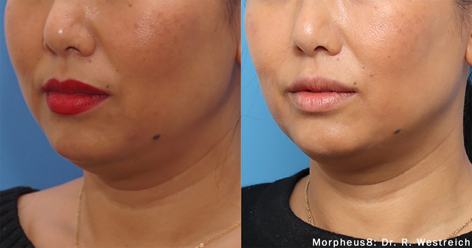 Morpheus8 Before/After Photos