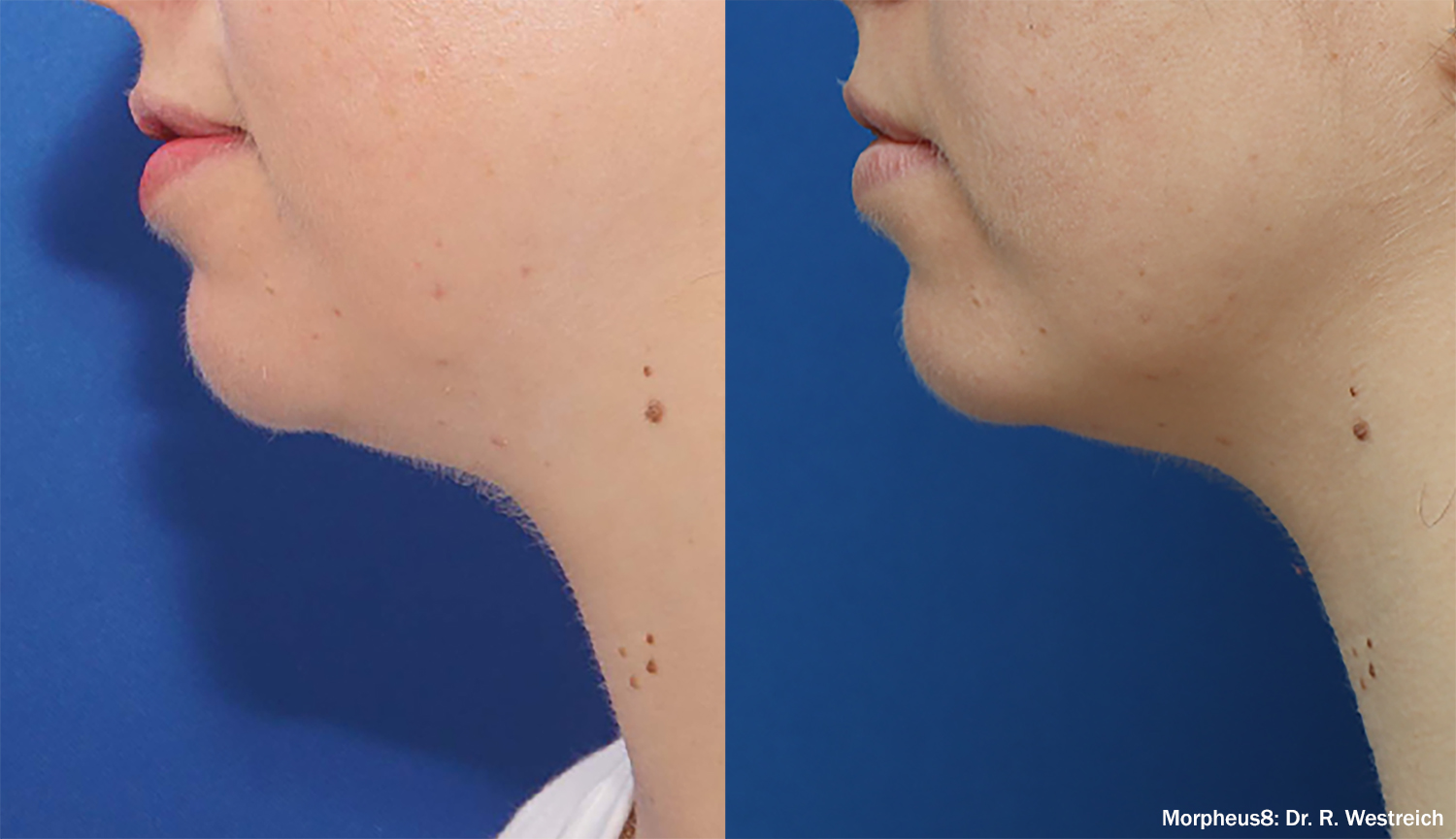 Morpheus8 Chin before/after photos